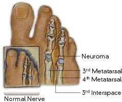 Mortons Neuroma