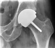 Hip Resurfacing Surgery